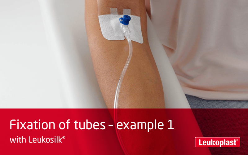 Denne video viser, hvordan et infusionssæt fastgøres ved hjælp af medicinsk tape til sensitiv hud: en sundhedspersons hænder fikserer et infusionssæt på en patients underarm med Leukosilk-tape.  Denne video viser, hvordan et infusionssæt fastgøres ved hjælp af medicinsk tape til sensitiv hud: en sundhedspersons hænder fikserer et infusionssæt på en patients underarm med Leukosilk-tape.